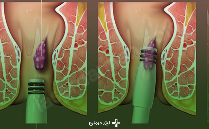 درمان هموروئید خارجی