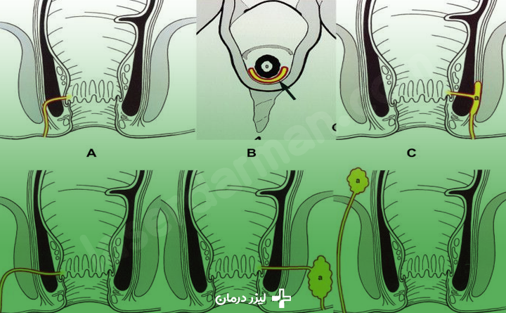 انواع فیستول مقعدی