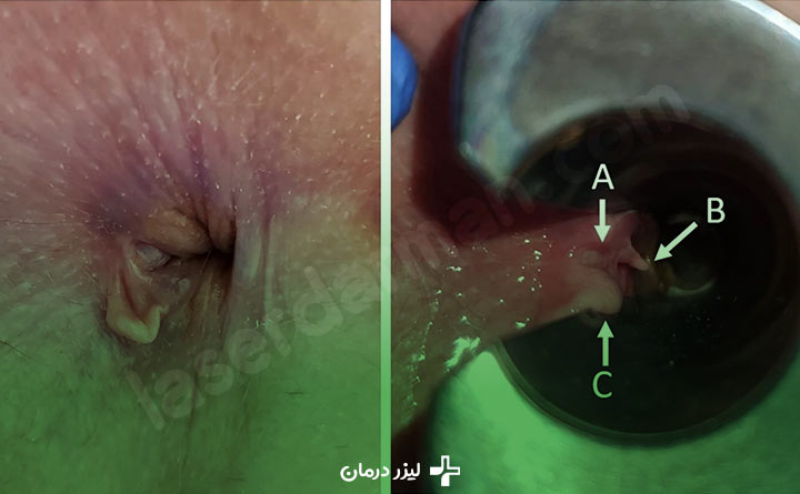 عمل بواسیر