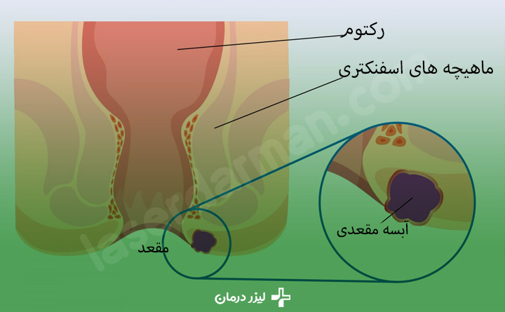 بیماری آبسه مقعدی