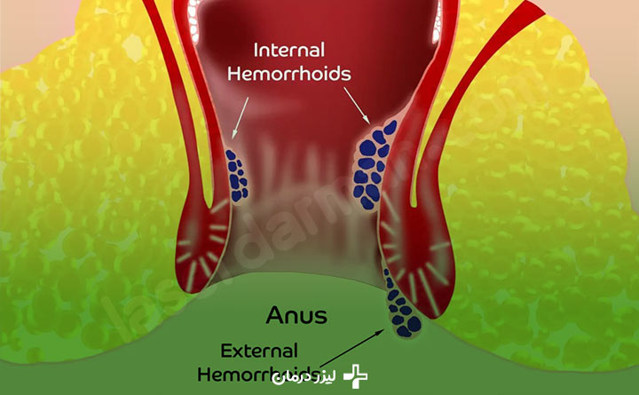 فرق بواسیر داخلی و خارجی