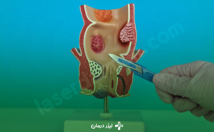 درد و ناراحتی بعد از عمل بواسیر