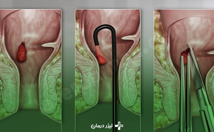 روش های مختلف درمان بیماری های مقعدی