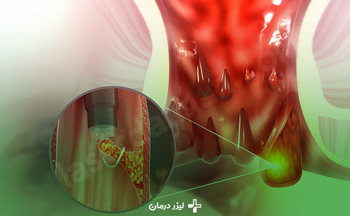 درمان فیشر با لیزر