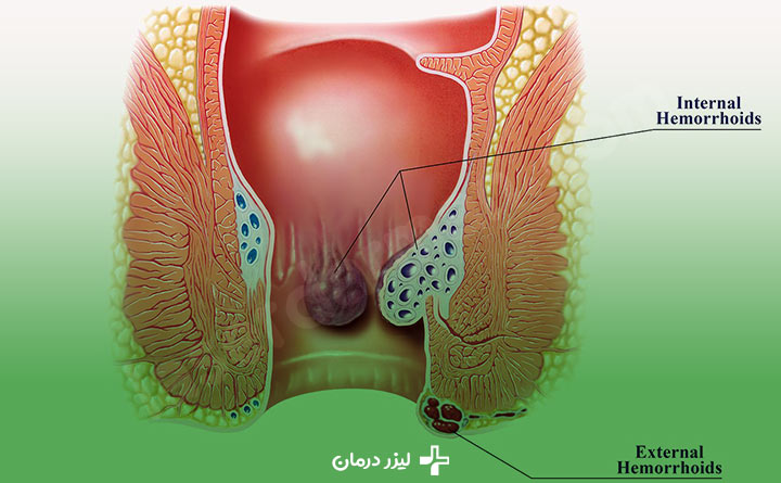 روش های مختلف درمان بواسیر چیست