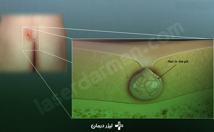 کیست مویی یا سینوس پیلونیدال