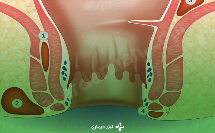 بیماری آبسه مقعدی