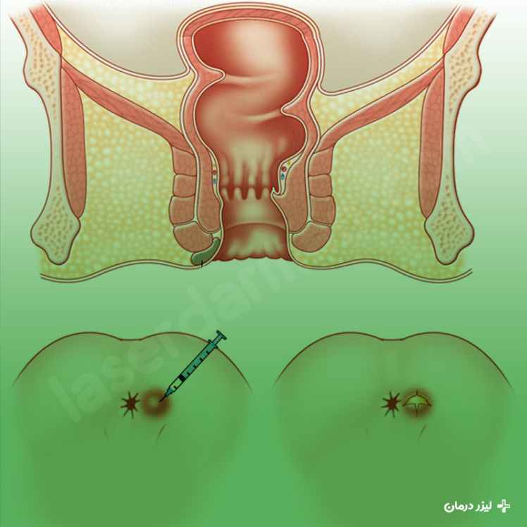 بیماری آبسه مقعدی چیست و چه علائمی دارد؟