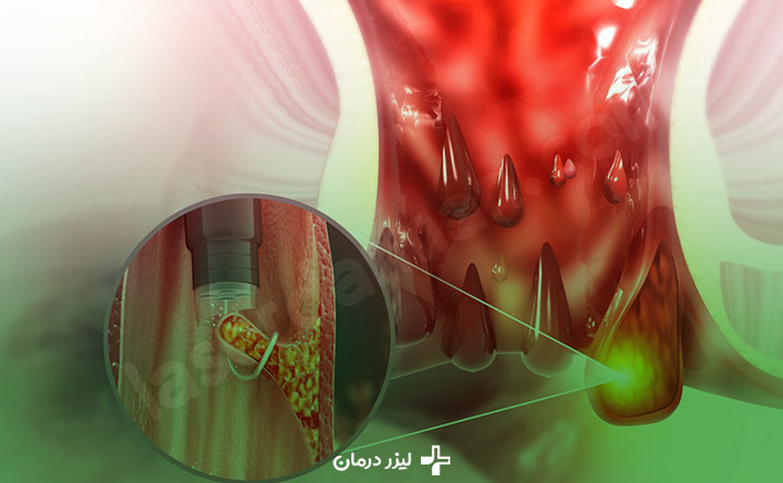 درمان بواسیر