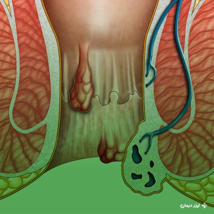 هموروئید چیست و چه علائمی دارد؟