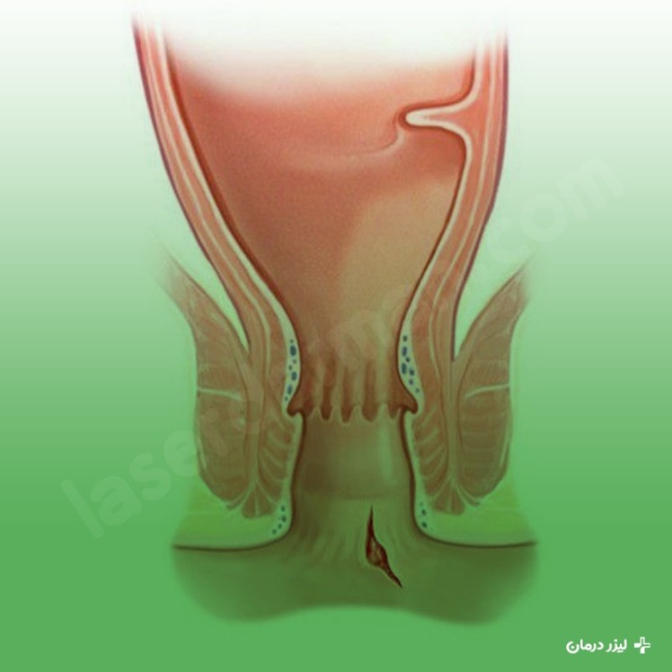 بهترین روش های درمان شقاق مقعدی یا فیشر | روش‌های خانگی، دارویی، پزشکی