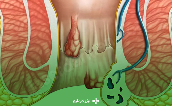 بواسیر داخلی و خارجی