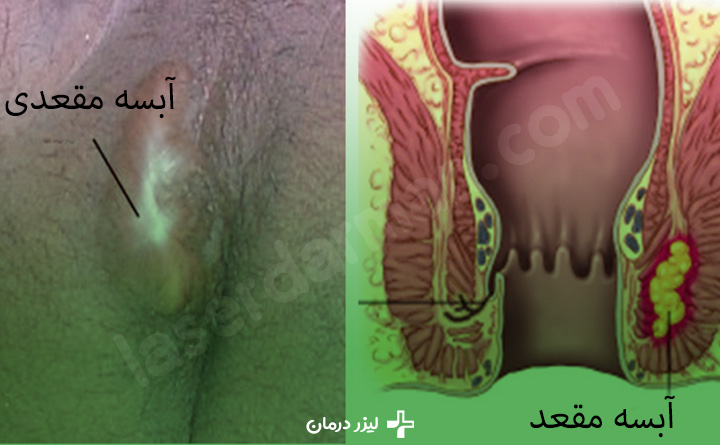 درمان آبسه مقعدی
