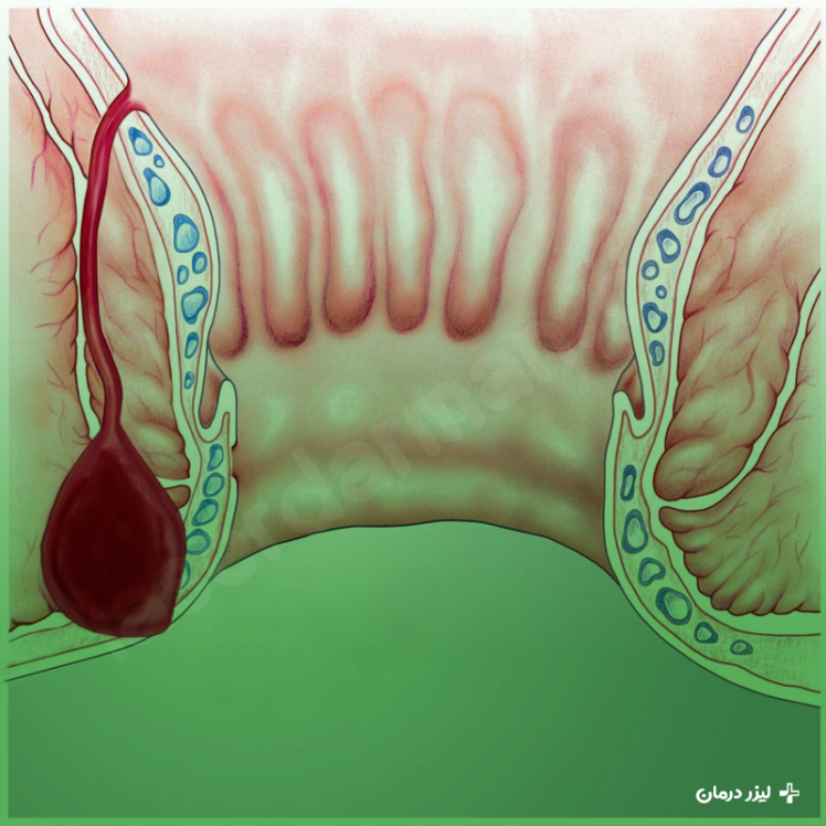 بیماری فیستول مقعدی چیست؟