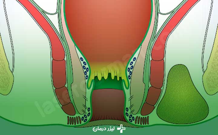 بیماری آبسه مقعدی