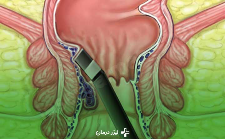 Fissure disease