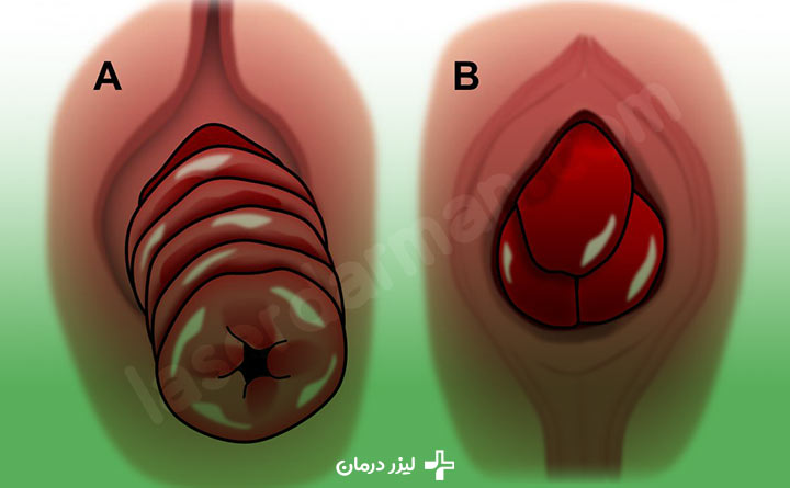 علائم بواسیر پرولاپس